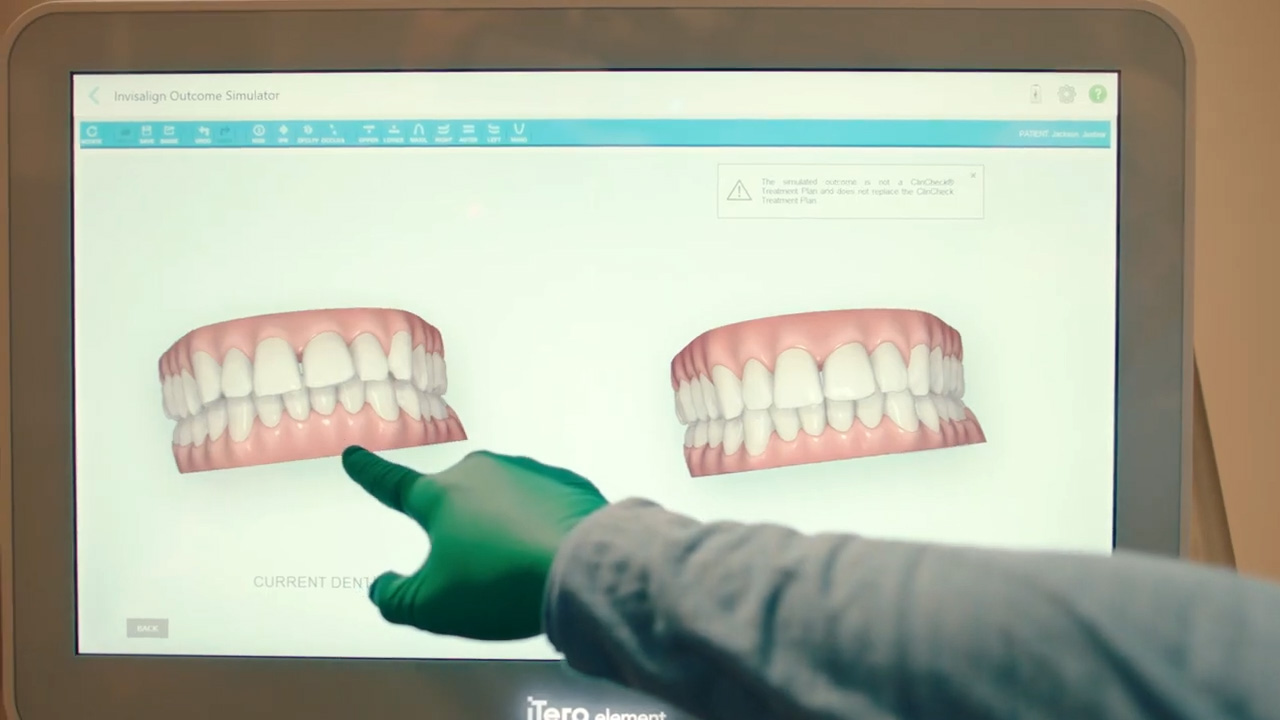 Get a precise 3D scan of your teeth with the iTero scanner.