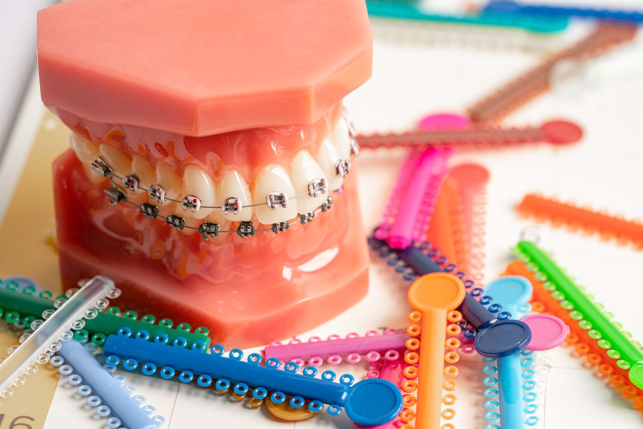 Dental braces with colorful ligatures, elastic ties that connect brackets to archwires.